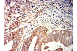 Immunohistochemical analysis of paraffin-embedded rectal cancer tissues using FGL1 mouse mAb with DAB staining.