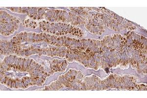 ABIN6273336 at 1/100 staining Human thyroid cancer tissue by IHC-P. (TSH receptor anticorps  (Internal Region))