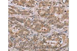 Immunohistochemistry of Human liver cancer using CLEC16A Polyclonal Antibody at dilution of 1:45 (CLEC16A anticorps)