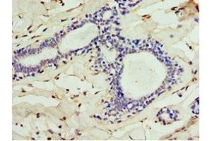 Immunohistochemistry of paraffin-embedded human breast cancer using ABIN7147563 at dilution of 1:100 (ALG1 anticorps  (AA 215-464))