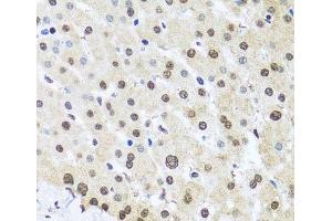 Immunohistochemistry of paraffin-embedded Human liver damage using FUBP1 Polyclonal Antibody at dilution of 1:100 (40x lens).