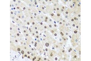 Immunohistochemistry of paraffin-embedded Human liver damage using FUBP1 Polyclonal Antibody at dilution of 1:100 (40x lens). (FUBP1 anticorps)