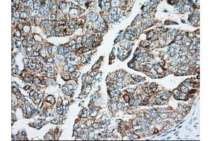 Immunohistochemical staining of paraffin-embedded Adenocarcinoma of Human breast tissue using anti-IGF2BP2 mouse monoclonal antibody. (IGF2BP2 anticorps)