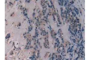 Detection of ALT in Human Breast cancer Tissue using Polyclonal Antibody to Alanine Aminotransferase (ALT)