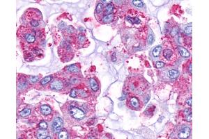 Anti-GPR161 antibody IHC of human Lung, Adenocarcinoma.