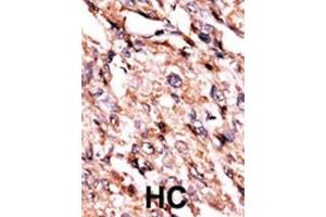 Formalin-fixed and paraffin-embedded human cancer tissue reacted with the primary antibody, which was peroxidase-conjugated to the secondary antibody, followed by AEC staining. (BCKDK anticorps  (AA 120-151))