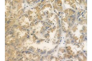 ABIN6259368 and ABIN6276097 at 1/100 staining human renal cell carcinoma by IHC-P.