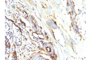 Formalin-fixed, paraffin-embedded human Colon Carcinoma stained with CD34 Recombinant Rabbit Monoclonal Antibody (HPCA1/2598R).