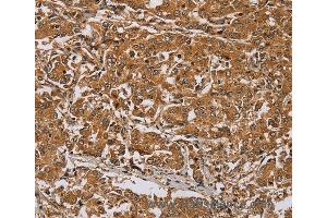 Immunohistochemistry of Human lung cancer using RAB8A Polyclonal Antibody at dilution of 1:45 (RAB8A anticorps)