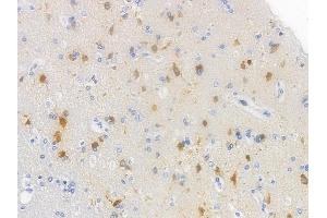 ABIN6254999 and ABIN6267500 at 1/100 staining human glioblastoma by IHC-P. (BRCA1 anticorps  (pSer1524))