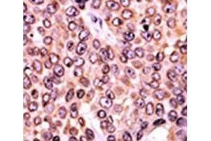 IHC analysis of FFPE human breast carcinoma tissue stained with the p-p21 antibody. (p21 anticorps  (pThr145))