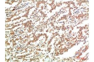 Immunohistochemical analysis of paraffin-embedded Human Lung Carcinoma Tissue using JAK2 Mouse mAb diluted at 1:200.