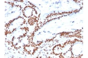 Formalin-fixed, paraffin-embedded human Colon Carcinoma stained with MSH2 Mouse Monoclonal Antibody (MSH2/2622).