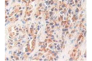 IHC-P analysis of Human Prostate Gland Cancer Tissue, with DAB staining. (Kallikrein 11 anticorps  (AA 39-282))