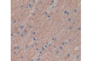 IHC-P analysis of Human Tissue, with DAB staining. (SFRP4 anticorps  (AA 265-346))