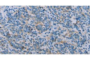 Immunohistochemistry of paraffin-embedded Human breast cancer using Claudin 4 Polyclonal Antibody at dilution of 1:35 (Claudin 4 anticorps)