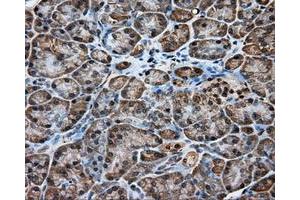 Immunohistochemical staining of paraffin-embedded Adenocarcinoma of ovary tissue using anti-RC200180 mouse monoclonal antibody. (KCTD5 anticorps)