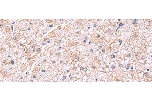 Immunohistochemistry of paraffin-embedded Human liver cancer tissue using PDRG1 Polyclonal Antibody at dilution of 1:75(x200) (PDRG1 anticorps)