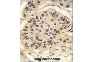 Formalin-fixed and paraffin-embedded human lung carcinoma tissue reacted with SOX2 Antibody (ABIN387798 and ABIN2843854) , which was peroxidase-conjugated to the secondary antibody, followed by DAB staining. (SOX2 anticorps)