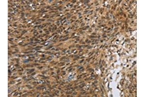 The image on the left is immunohistochemistry of paraffin-embedded Human cervical cancer tissue using ABIN7190675(FOXB1 Antibody) at dilution 1/30, on the right is treated with synthetic peptide. (FOXB1 anticorps)