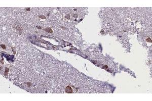 ABIN6276388 at 1/100 staining Human brain cancer tissue by IHC-P. (ACVR1C/ALK7 anticorps  (C-Term))