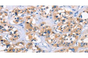 Immunohistochemistry of paraffin-embedded Human thyroid cancer tissue using APOL6 Polyclonal Antibody at dilution 1:50 (APOL6 anticorps)