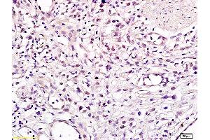 Formalin-fixed and paraffin embedded human gastric carcinoma labeled with Anti CHMP1A Polyclonal Antibody, Unconjugated (ABIN705236) at 1:200 followed by conjugation to the secondary antibody and DAB staining (CHMP1A anticorps  (AA 51-150))