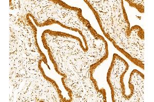 ABIN7094791 and ABIN7098842 at 1/100 staining Human kidney cancer by IHC-P.