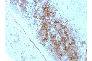 Formalin-fixed, paraffin-embedded human Melanoma stained with CD63 Mouse Monoclonal Antibody (LAMP3/2789). (CD63 anticorps  (AA 100-197))