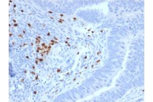 Formalin-fixed, paraffin-embedded human Colon Carcinoma stained with RET Mouse Monoclonal Antibody (RET/2795).