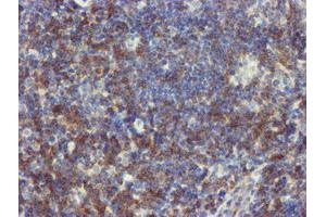 Immunohistochemical staining of paraffin-embedded Human lymphoma tissue using anti-NMT2 mouse monoclonal antibody. (NMT2 anticorps)