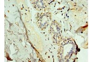 Immunohistochemistry of paraffin-embedded human breast cancer using ABIN7143736 at dilution of 1:100 (FUT6 anticorps  (AA 170-359))