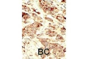 Formalin-fixed and paraffin-embedded human cancer tissue reacted with the primary antibody, which was peroxidase-conjugated to the secondary antibody, followed by DAB staining.