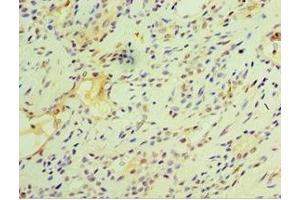 Immunohistochemistry of paraffin-embedded human breast cancer using ABIN7153127 at dilution of 1:100