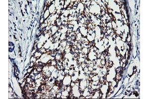 Immunohistochemical staining of paraffin-embedded Adenocarcinoma of Human breast tissue using anti-ERBB2 mouse monoclonal antibody. (ErbB2/Her2 anticorps  (AA 676-1255))