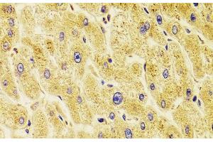 Immunohistochemistry of paraffin-embedded Human liver damage using TXNL1 Polyclonal Antibody at dilution of 1:100 (40x lens). (TXNL1 anticorps)