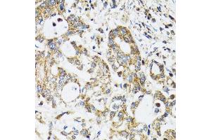 Immunohistochemistry of paraffin-embedded human colon carcinoma using EPB41 antibody (ABIN1872554) at dilution of 1:100 (40x lens). (EPB41 anticorps)