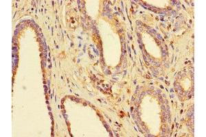 Immunohistochemistry of paraffin-embedded human prostate cancer using ABIN7160076 at dilution of 1:100 (BUB3 anticorps  (AA 6-217))