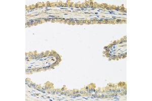 Immunohistochemistry of paraffin-embedded human prostate using CRHBP antibody (ABIN5973945) at dilution of 1/100 (40x lens). (CRHBP anticorps)