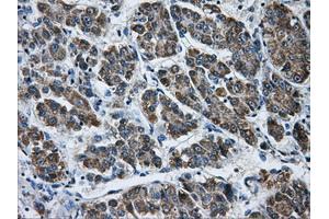Immunohistochemical staining of paraffin-embedded Carcinoma of liver tissue using anti-AKR1A1mouse monoclonal antibody. (AKR1A1 anticorps)