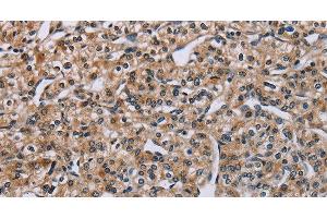 Immunohistochemistry of paraffin-embedded Human prostate cancer tissue using PNPT1 Polyclonal Antibody at dilution 1:40 (PNPT1 anticorps)