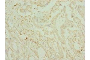Immunohistochemistry of paraffin-embedded human pancreatic cancer using ABIN7149016 at dilution of 1:100 (CDO1 anticorps  (AA 1-200))