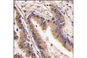 Formalin-fixed and paraffin-embedded human lung carcinoma tissue reacted with ERK4 antibody (C-term), which was peroxidase-conjugated to the secondary antibody, followed by DAB staining.