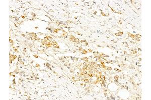 ABIN6255610 and ABIN6267632 at 1/100 staining Human breast cancer by IHC-P.