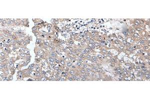 Immunohistochemistry of paraffin-embedded Human liver cancer tissue using BRMS1L Polyclonal Antibody at dilution of 1:45(x200) (BRMS1L anticorps)
