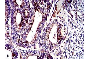Immunohistochemical analysis of paraffin-embedded lung cancer tissues using CD107b mouse mAb with DAB staining.