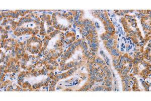 Immunohistochemistry of paraffin-embedded Human thyroid cancer tissue using BST1 Polyclonal Antibody at dilution 1:50 (BST1 anticorps)