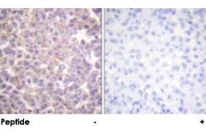 Immunohistochemical analysis of paraffin-embedded human breast carcinoma tissue using ERBB3 polyclonal antibody . (ERBB3 anticorps)