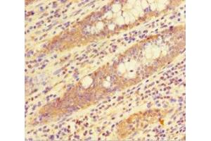 Immunohistochemistry of paraffin-embedded human colon cancer using ABIN7155348 at dilution of 1:100