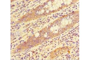 Immunohistochemistry of paraffin-embedded human colon cancer using ABIN7155348 at dilution of 1:100 (HIST1H1C anticorps  (AA 2-213))